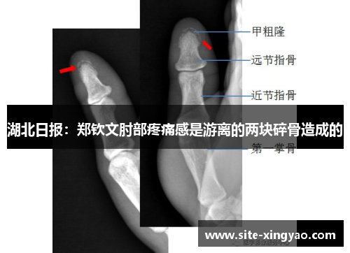 湖北日报：郑钦文肘部疼痛感是游离的两块碎骨造成的